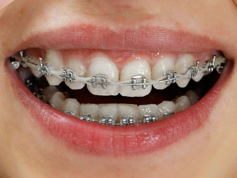 Dịch vụ chỉnh nha truyền thống