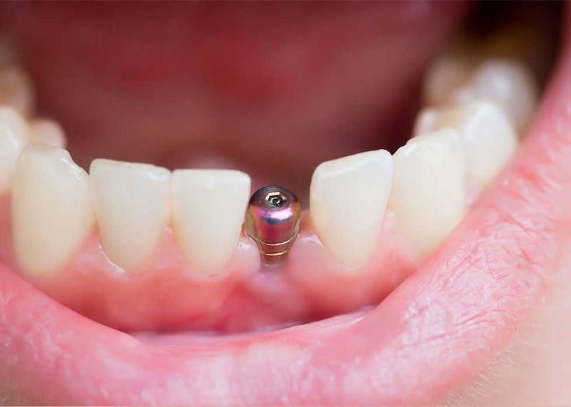Dịch vụ trồng răng Implant