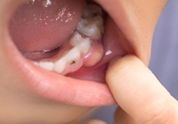 Áp xe răng gây đau nhức và ảnh hưởng đến sức khỏe nếu không điều trị kịp thời