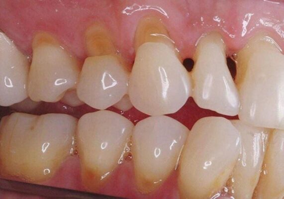 Mòn cổ răng là bệnh lý không thể tự phục hồi