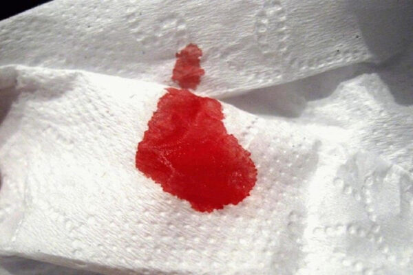 Nước bọt lẫn máu có thể là biểu hiện sớm của những bệnh lý nguy hiểm liên quan đến răng miệng, đường tiêu hóa hoặc hô hấp