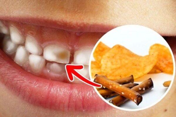 Đồ ăn nhiều đường, carbohydrate tinh chế gây sâu răng