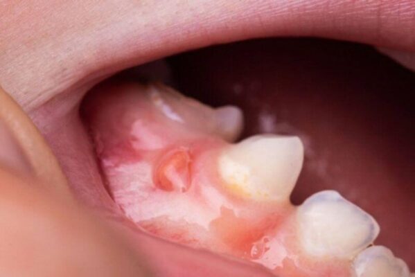 Hệ miễn dịch suy giảm cũng dẫn đến viêm ở mô quanh răng