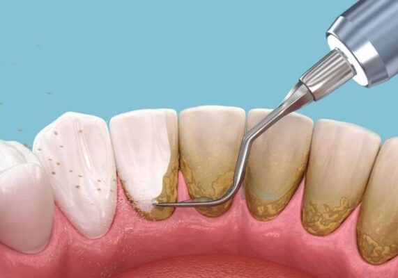 Cạo vôi răng giúp loại bỏ mảng bám tích tụ lâu ngày