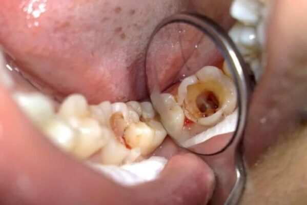 Viêm tủy răng có thể dẫn đến phản ứng hạch