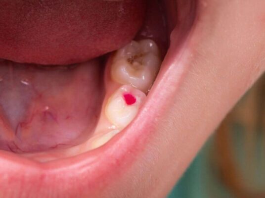 Viêm tủy răng có thể khiến người bệnh mất tủy răng nếu không điều trị kịp lúc