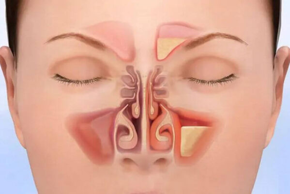 Xoang hàm bị viêm có thể gây đau nhức răng