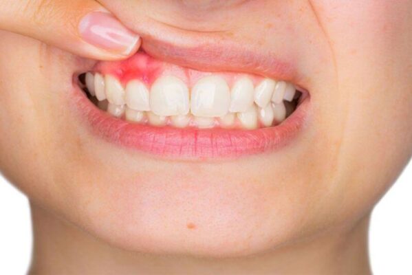 Tình trạng viêm mô nướu sau khi bọc mão sứ