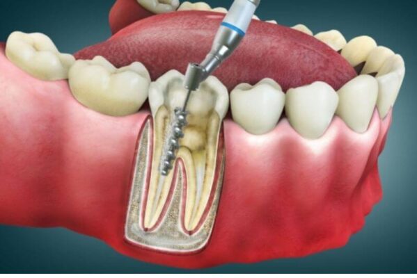 Viêm tủy sau khi trồng sứ cần can thiệp sớm