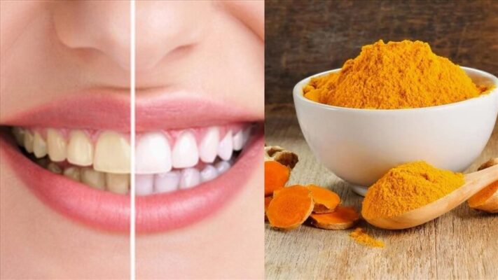 Bột nghệ có khả năng làm sáng răng hiệu quả
