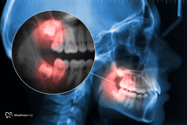 Nguyên nhân gây ê buốt răng không chỉ gây khó chịu khi ăn uống mà còn ảnh hưởng đến chất lượng cuộc sống hàng ngày