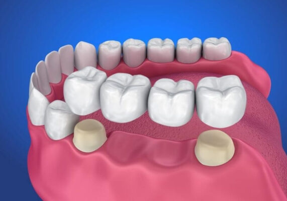 Làm cầu răng sứ dùng một dãy mão sứ gắn cố định lên hai răng thật 