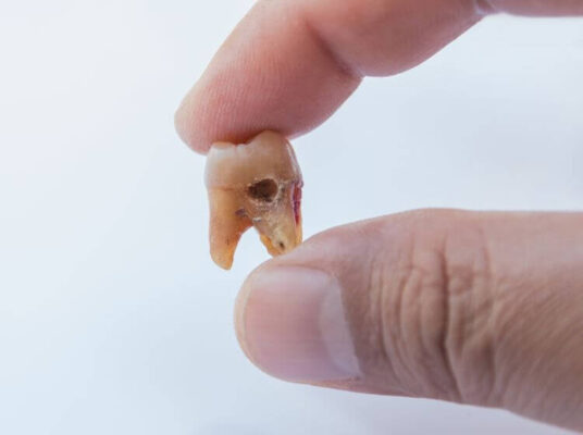 Răng bị sâu không chỉ gây khó chịu, đau đớn mà còn là kẻ thù thầm lặng, âm thầm phá hủy sức khỏe người bệnh