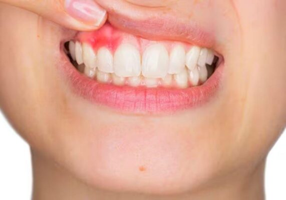 Sưng lợi là dấu hiệu cảnh báo nhiều bệnh lý răng miệng tiềm ẩn