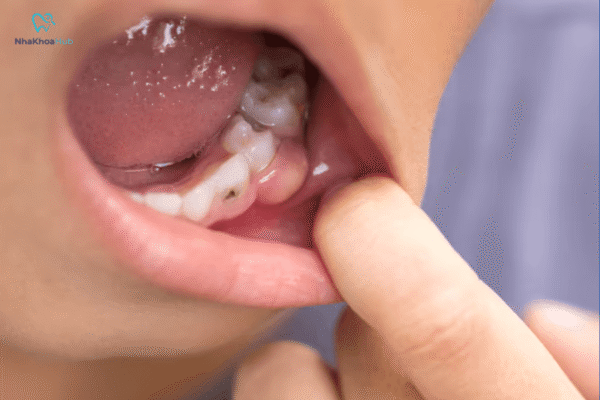 Lựa chọn đúng sản phẩm và sử dụng đúng cách sẽ giúp ngăn ngừa nguy cơ viêm nha chu, tụt lợi, mất răng