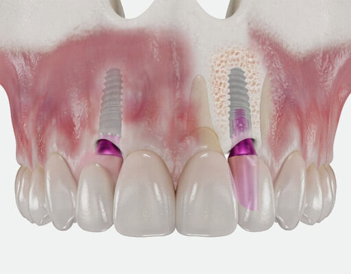 Trồng răng giá rẻ nên được xem xét kỹ để đảm bảo độ an toàn và tính hiệu quả