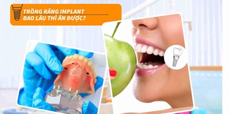 Trồng răng Implant bao lâu thì ăn được?