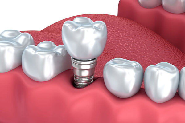 Cấy ghép Implant là giải pháp hữu hiệu với những người mất một răng hoặc nhiều răng