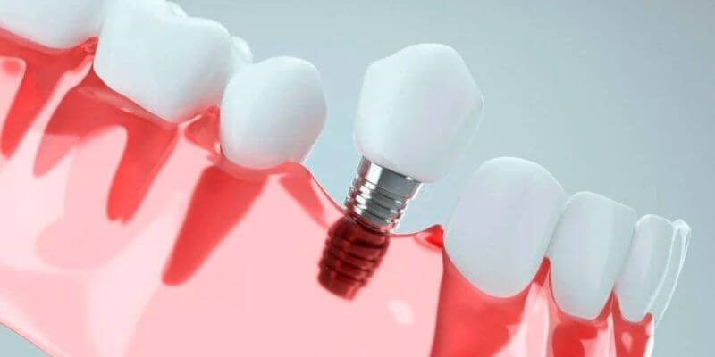 Tổng quan về trồng răng implant tại Đài Loan