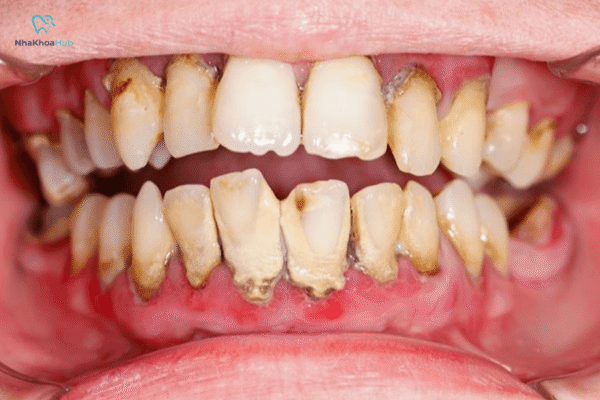 Đây là tình trạng viêm nhiễm nghiêm trọng làm tổn thương mô nướu và xương nâng đỡ răng