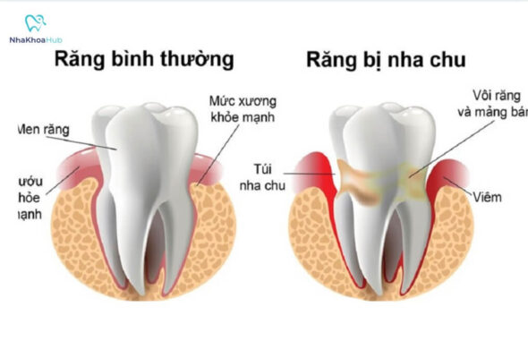 Bệnh nếu không được điều trị đúng cách có thể dẫn tới mất răng 