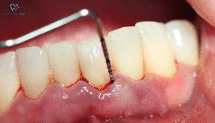 Viêm nha chu là tình trạng nhiễm trùng các mô xung quanh răng, có thể gây đau đớn, viêm nhiễm nặng, thậm chí mất răng nếu không được điều trị kịp thời