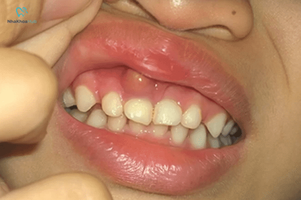 Trẻ trong độ tuổi học mẫu giáo và tiểu học rất dễ bị ảnh hưởng nếu không được chăm sóc răng miệng đúng cách