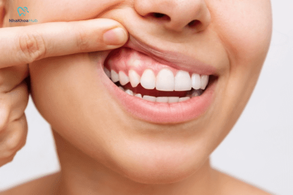  Chế độ dinh dưỡng khoa học sẽ góp phần rất lớn vào việc giảm viêm, tái tạo mô trong miệng