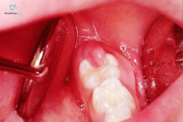 Tình trạng này thường gây sưng, đỏ và đau nhức nướu, làm ảnh hưởng đến quá trình ăn uống 