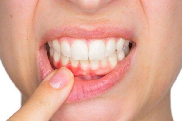 Viêm chân răng dùng thuốc gì cần theo chỉ định của nha sĩ