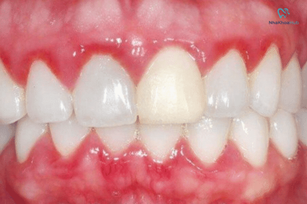 Tình trạng này nếu không được phát hiện và xử lý kịp thời sẽ dẫn đến những biến chứng nguy hiểm