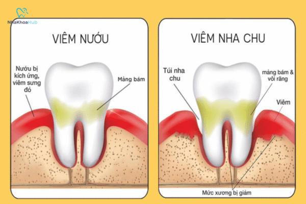 Viêm nướu và bệnh nha chu là hai bệnh lý răng miệng phổ biến
