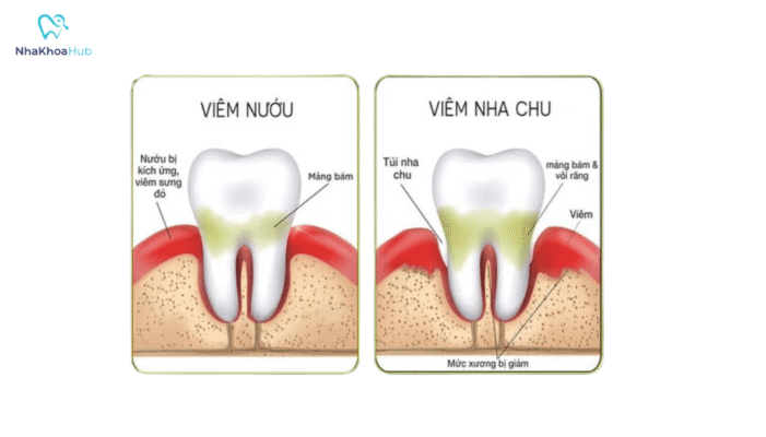 Điều trị đúng cách, tránh được các biến chứng nguy hiểm và duy trì sức khỏe răng miệng lâu dài