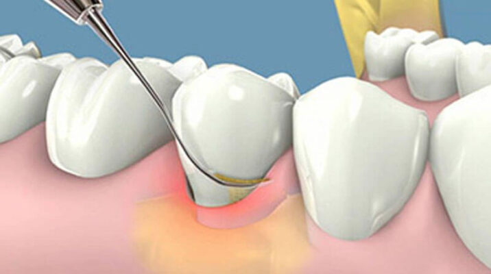 Việc làm sạch cao răng tại nhà không đúng cách có thể khiến men răng bị tổn thương