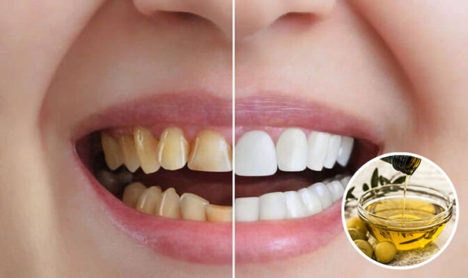 Làm trắng răng bằng dầu ô liu được nhiều người lựa chọn nhờ tính an toàn, tiết kiệm và dễ thực hiện