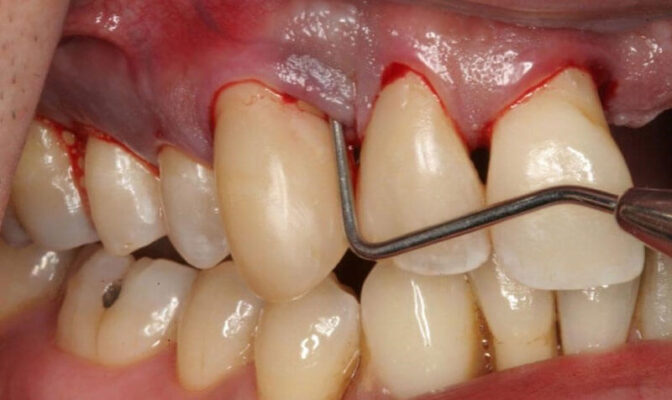 Lấy cao răng giúp ngăn ngừa các bệnh lý răng miệng nhưng thực hiện sai cách gây ra rủi ro nghiêm trọng