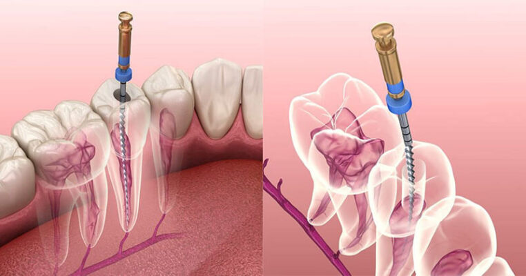 Điều trị tủy có đặc thù phức tạp nên chi phí chịu ảnh hưởng bởi nhiều yếu tố
