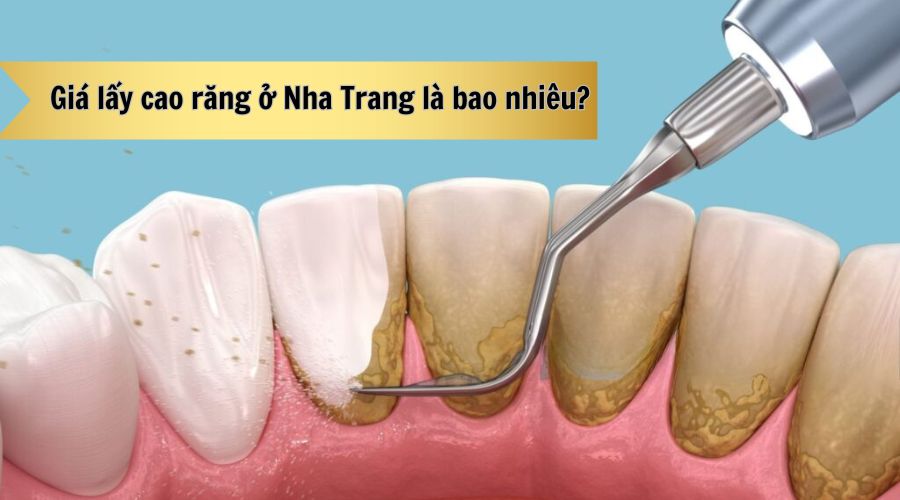 Giá lấy cao răng ở Nha Trang được nhiều người dân địa phương quan tâm khi có nhu cầu chăm sóc sức khỏe răng miệng định kỳ