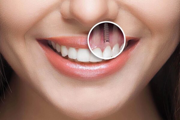 Hiểu đúng những trường hợp không nên trồng răng Implant giúp người bệnh tránh những rủi ro không đáng có
